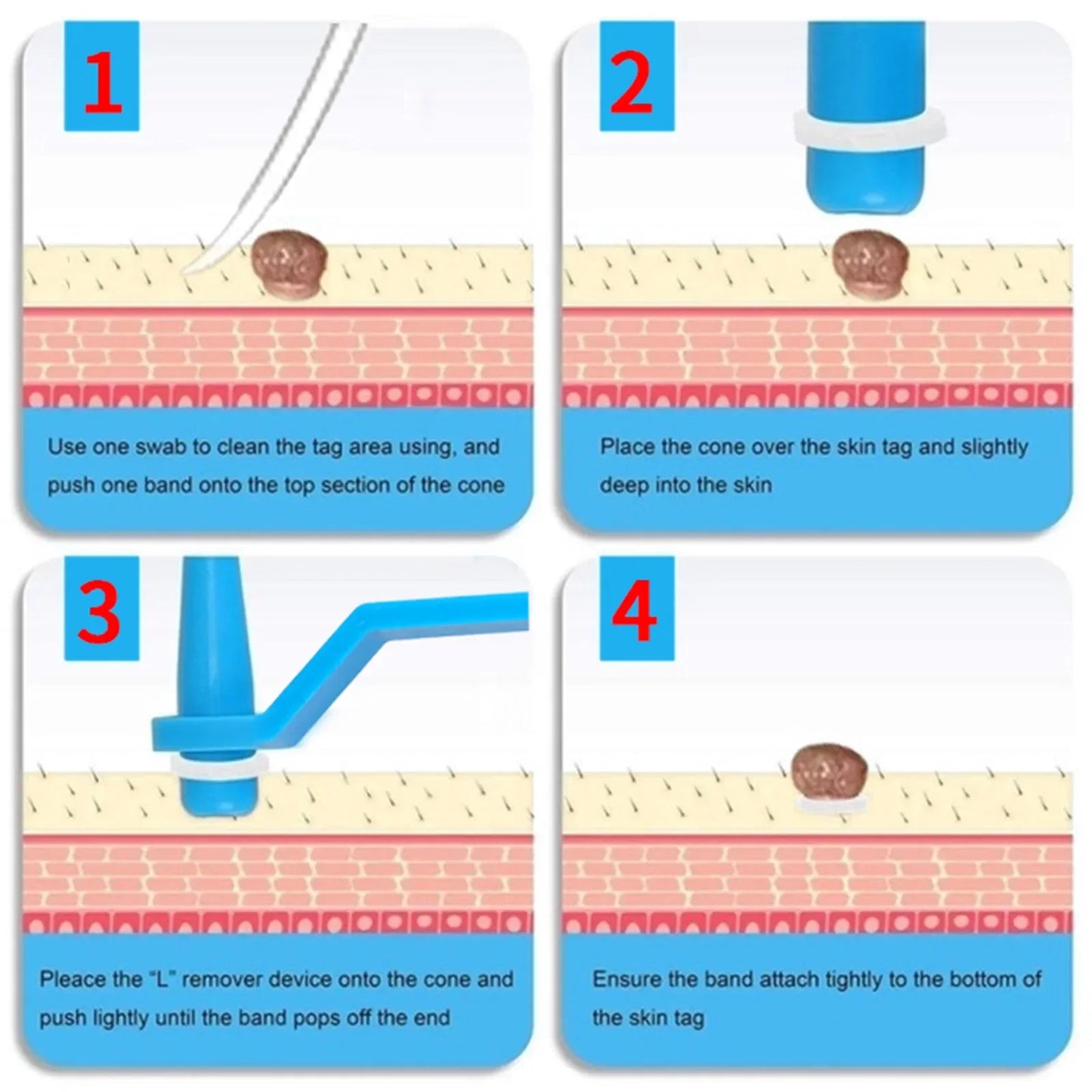 30Pcs Skin Tag Removal Rubber Bands Micro Band Non Toxic Mole Wart Micro Refill Band Skin Tag Removal Bands Skin Care Tools 2026